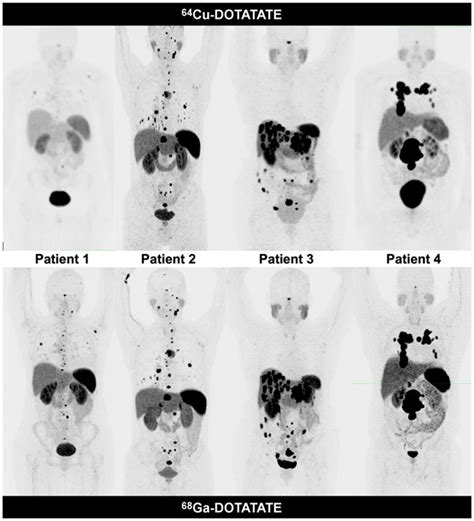 Comparison of MRI, 64.